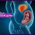 بیماری کبد در دوران بارداری