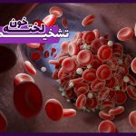 تشخیص لخته خون